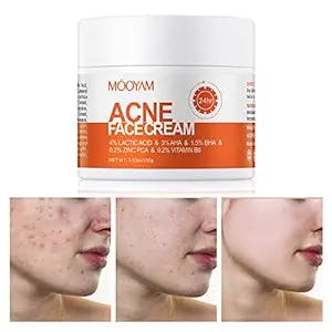 Acne Treatment for Face, Salicylic Acid Acne Cream Back Acne Treatment Cream for Teens & Adults Anti-acne Moisturizer Pimple Cream Butt Acne Clearing Cream, Acne Spot Treatment for Breakouts Blemish